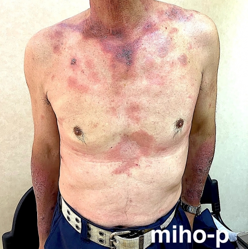 慢性湿疹の改善例